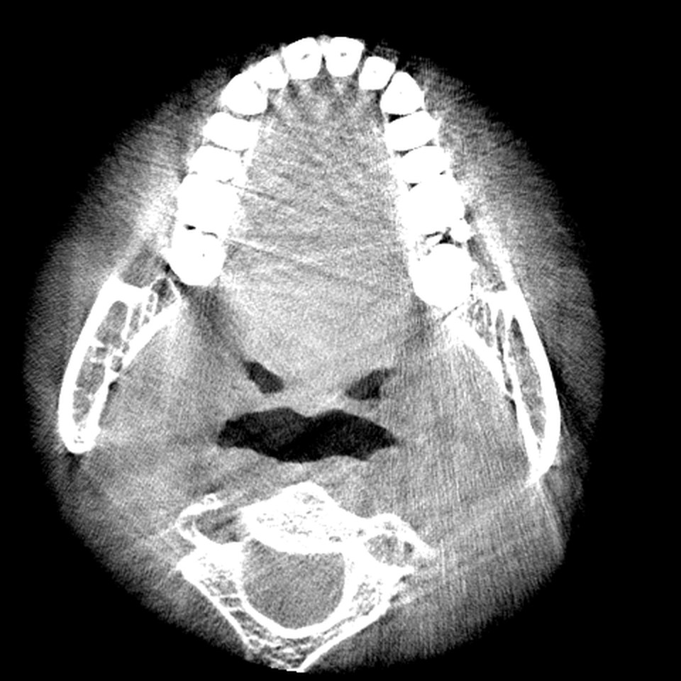 The same axial CBCT slice in the soft tissue window, bone saturated white and the tongue and cheeks visible